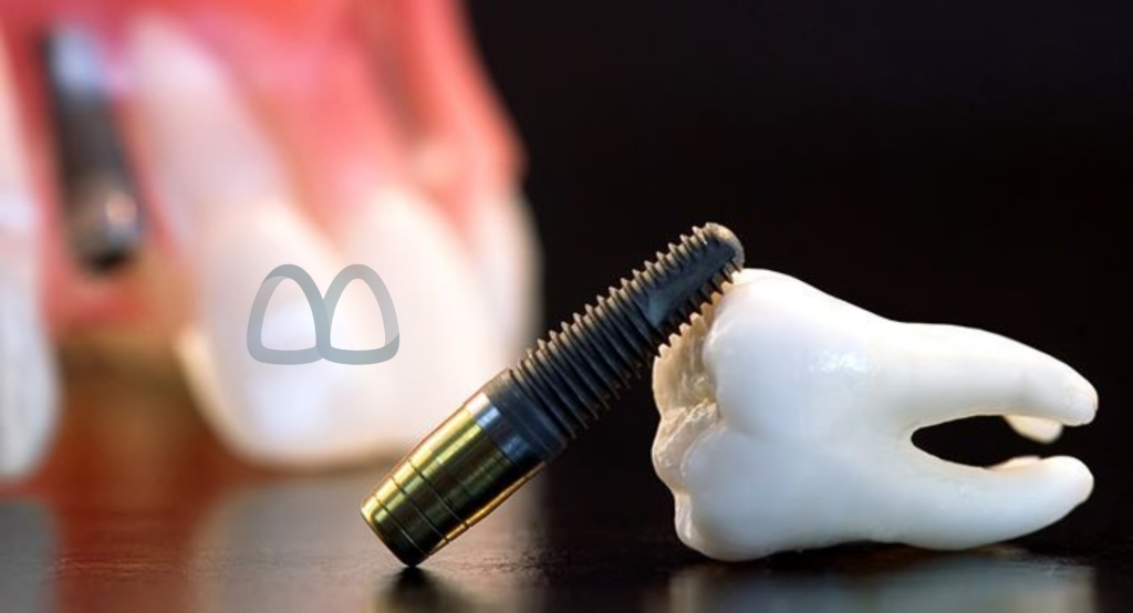 ایمپلنت دندان dental implant