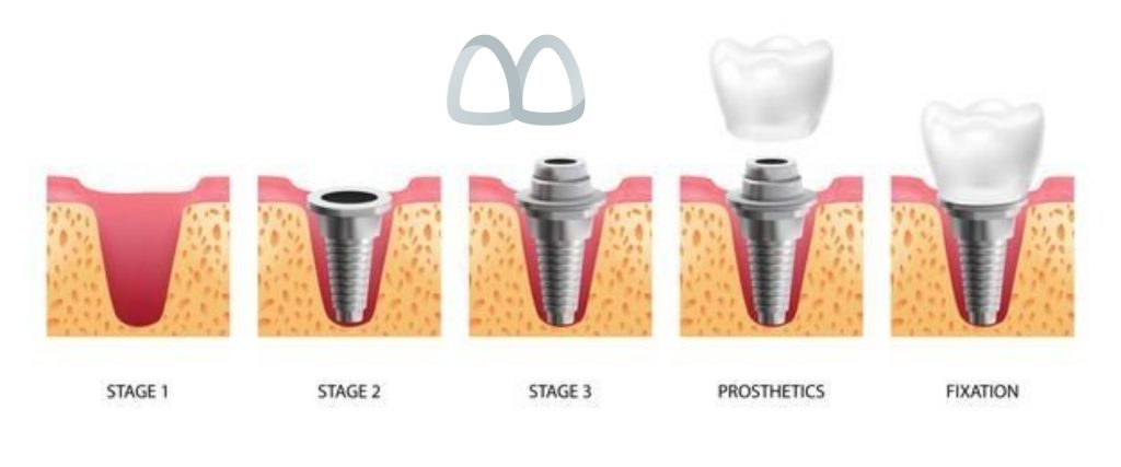 مراحل ایمپلنت